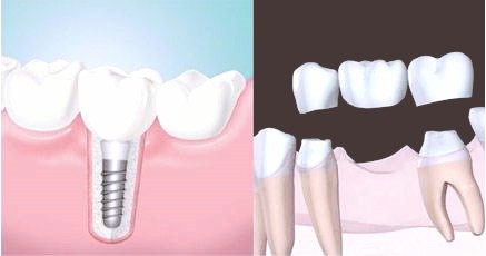 造成牙齿缺失的原因是什么