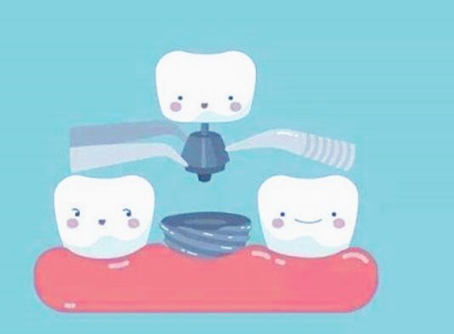 牙齿缺失怎么修复效果好