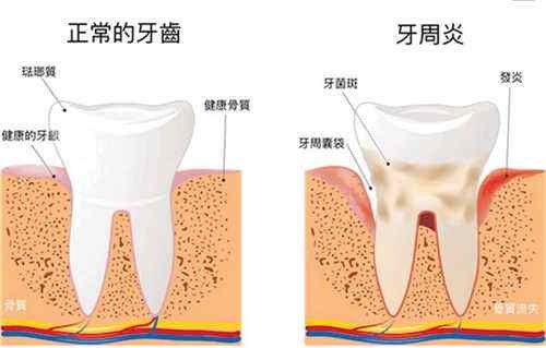 【牙科问题老实答】补牙后银汞合金可以换成树脂吗