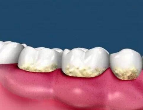 洛阳九龙口腔告诉你牙结石对牙周健康的危害