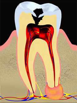 洛阳九龙口腔教你如何鉴别急性根尖周炎与急性牙髓炎?