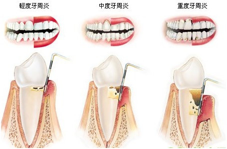 洛阳九龙口腔介绍周疾病的五个阶段