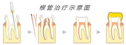 九龙提醒：牙齿根管治疗有严格的操作标准