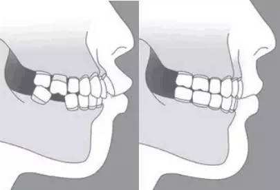 牙齿掉了有什么危害？
