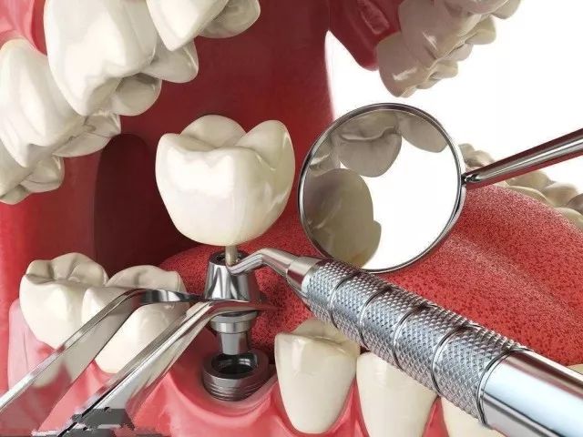 牙齿缺失了如何修复好呢？