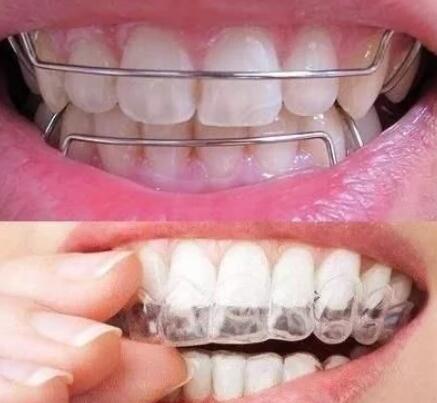 洛阳九龙口腔：成人牙齿矫正后是否需要佩戴保持器