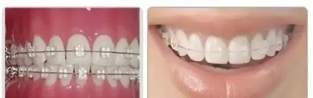 洛阳九龙口腔：牙齿正畸需要多长时间?