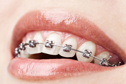 洛阳牙齿矫正专家：上排牙齿不齐，只矫上排牙齿可以吗？