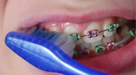 洛阳牙友提问：牙齿矫正时间能不能缩短些？