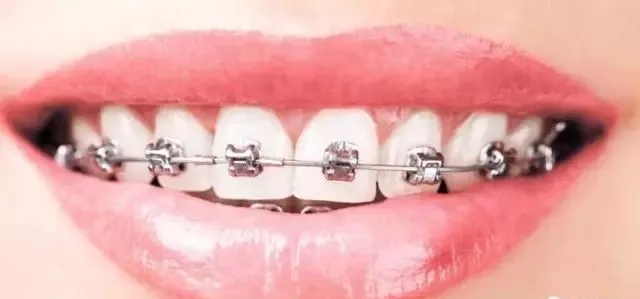 洛阳九龙口腔:牙齿不齐进行牙齿正畸时，是不是会特别疼？