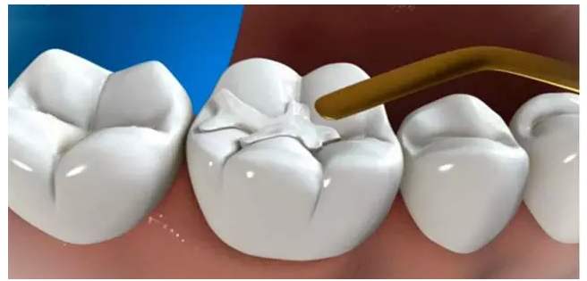 牙齿缺损怎么修复?