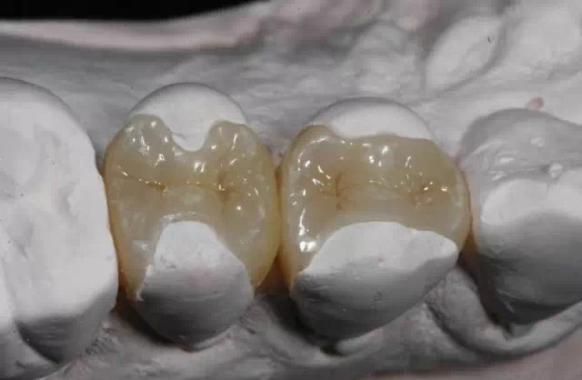 在洛阳，治疗牙齿缺损多少钱？