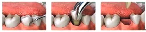 洛阳九龙口腔：哪些牙齿需要拔除？