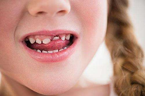 小孩乳牙蛀牙了会有影响吗？