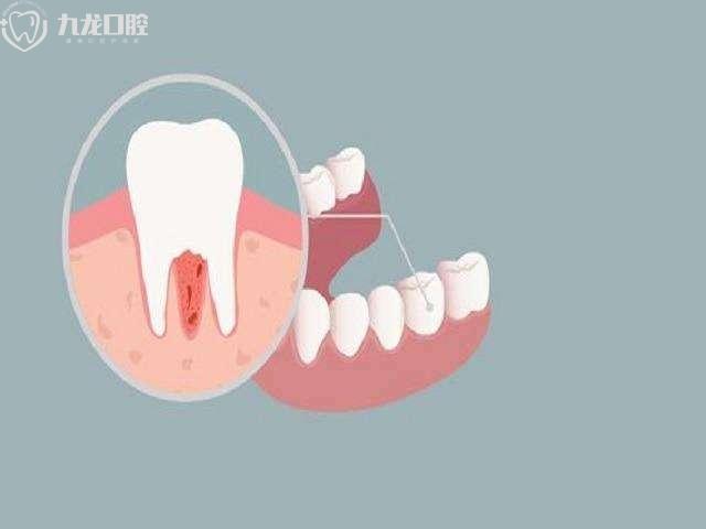 牙周炎的治疗方式