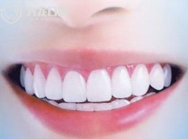 牙齿矫正的好处是什么?