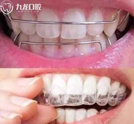 牙齿矫正后的保持器类型