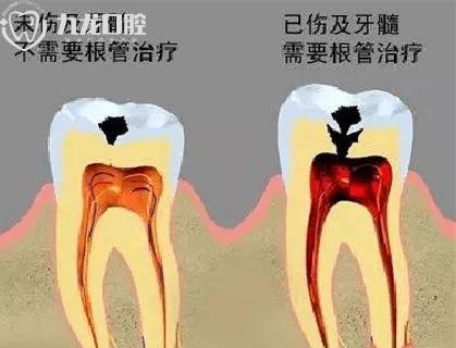补牙及根管治疗