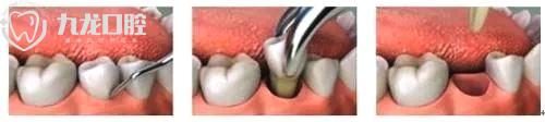 洛阳九龙口腔：哪些牙齿需要拔除？